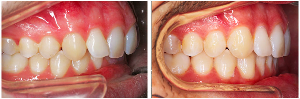 profil-dents-bonheur-avant-apres-invisalign