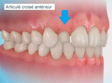 articule-croise-anterieur