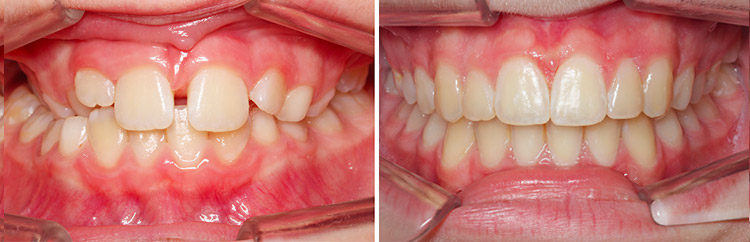 articule-croise-droite-deviation-enfant