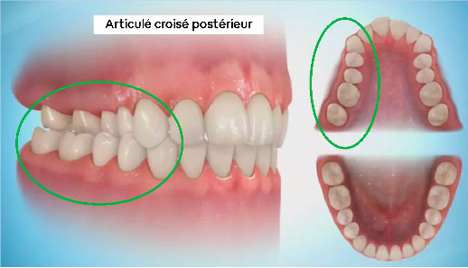 articule-croise-posterieur