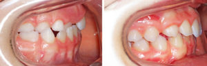 avant-apres-orthodontie-articule-croise-enfant-profilD