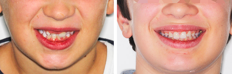 avant-apres-orthodontie-enfant-prognathe-face