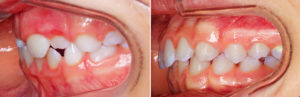 avant-apres-orthodontie-enfant-prognathe-profilG