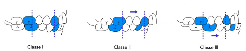 orthodontie classe I, II, III