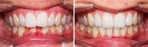 avant-après-supraclusion-surplomb-surocclusion-recouvrement-face