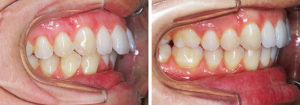 avant-après-supraclusion-surplomb-surocclusion-recouvrement-profil
