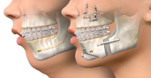 chirurgie-avant-apres-recouvrement-orthodontie-overbite