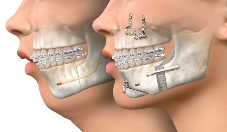 chirurgie-avant-apres-recouvrement-orthodontie-overbite
