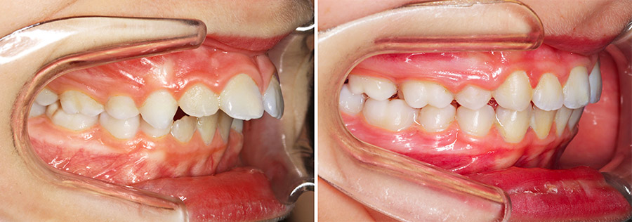 enfant-dents-haut-en-avant-surplomb-surocclusion-recouvrement-profil