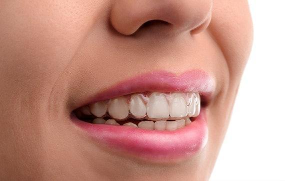 invisalign-orthodontie-recouvrement