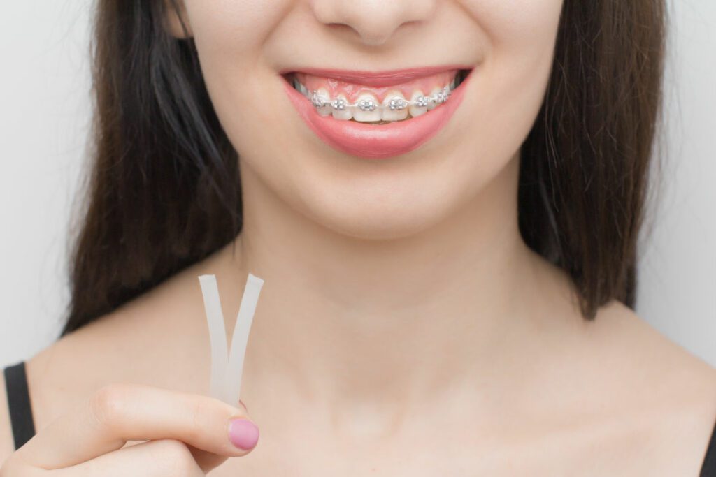 Cire orthodontique pour prot&eacute;ger les joues des bagues &ndash; orthodontiste Paris, bagues m&eacute;tal