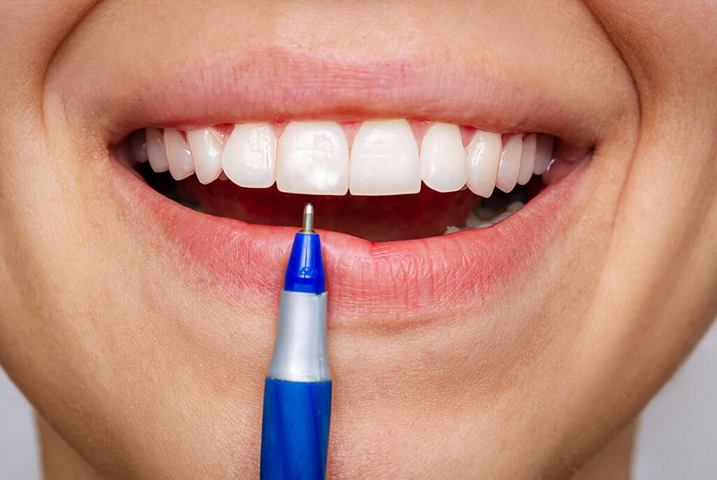 Taches blanches de déminéralisation sur les dents pendant un traitement orthodontique – orthodontiste Paris, bagues et aligneurs